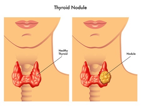 healthy thyroid VS nodule thyroid