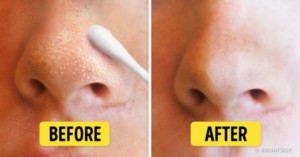 Before and After Blackheads