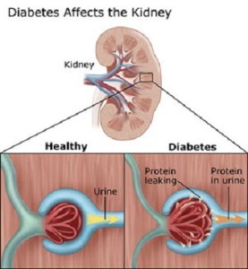 Diabetic Nephropathy