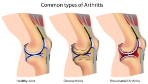 Arthritis