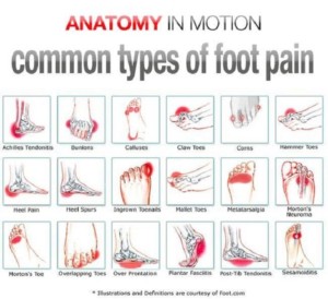 Types of Foot Pain